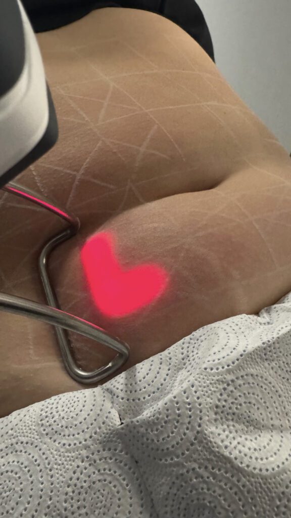 Czym jest lipoliza laserowa Vivien 1064 i jakie są zasady jej działania